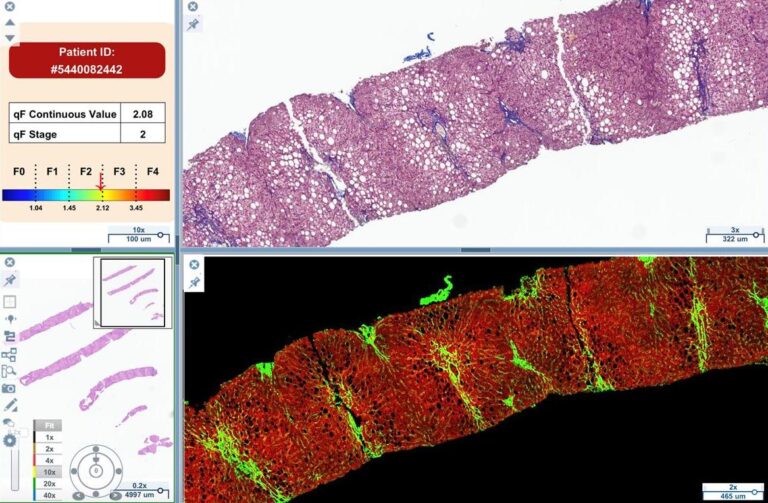 qfibrosis