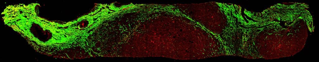 SHG Image of Fibrosis in a Liver Biopsy. Collagen in Green, Hepatocytes and Immune Cells in Red