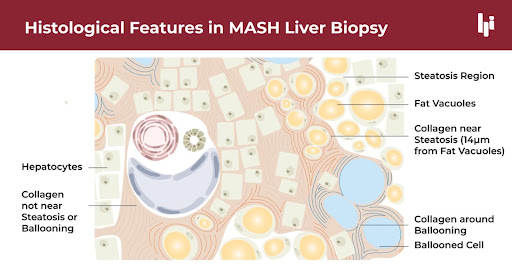 histological features in MASH liver biopsy